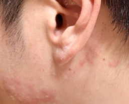 귀가 아픈데 물집까지 생겼다면… 대상포진일 수 있는 이유 3 image 40