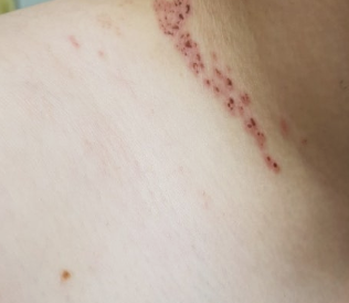 목 한쪽이 따끔하고 피부까지 아프다면 대상포진 가능성은? 1 image 51