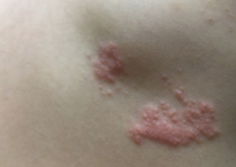가슴 한쪽이 찌릿하고 물집이 생겼다면… 대상포진에서 흔히 보이는 모습 3 image 59