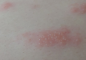 옆구리가 화끈하고 스치기만 해도 아프다면… 대상포진일까? 3 옆구리 대상포진 증상