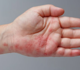 손가락에 물집이 생겼는데 계속 아프다면… 대상포진 가능성은? 1 손가락 대상포진증상