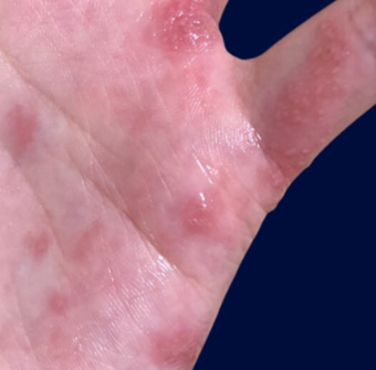 손가락에 물집이 생겼는데 계속 아프다면… 대상포진 가능성은? 3 손가락 대상포진증상