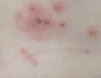 엉덩이 한쪽이 화끈거리고 물집이 생겼다면 대상포진일 수 있습니다 4 엉덩이 대상포진증상