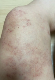 허벅지 한쪽이 따끔하고 피부가 예민해졌다면 대상포진일까? 3 허벅지 대상포진증상