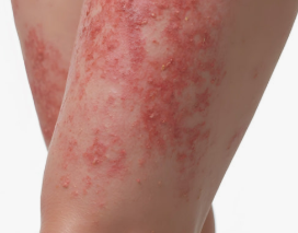허벅지 한쪽이 따끔하고 피부가 예민해졌다면 대상포진일까? 4 허벅지 대상포진증상
