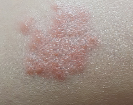 허벅지 한쪽이 따끔하고 피부가 예민해졌다면 대상포진일까? 6 허벅지 대상포진증상