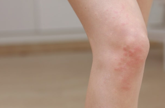 무릎이 아픈 줄 알았는데 피부까지 따끔하다면… 대상포진 확인 1 무릎 대상포진증상