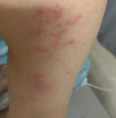 무릎이 아픈 줄 알았는데 피부까지 따끔하다면… 대상포진 확인 2 무릎 대상포진증상
