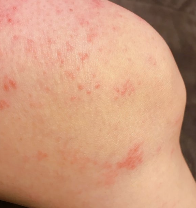 무릎이 아픈 줄 알았는데 피부까지 따끔하다면… 대상포진 확인 3 무릎 대상포진증상