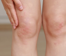 무릎이 아픈 줄 알았는데 피부까지 따끔하다면… 대상포진 확인 5 무릎 대상포진증상